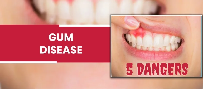 5 Dangers of Untreated Gum Disease