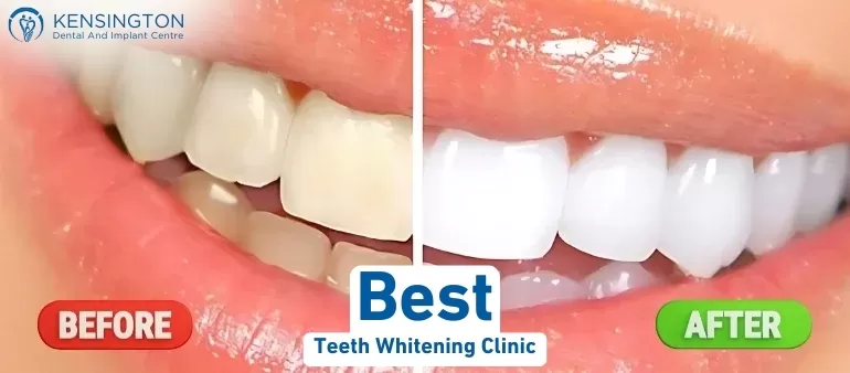 Best Teeth whitening Clinic in Islamabad