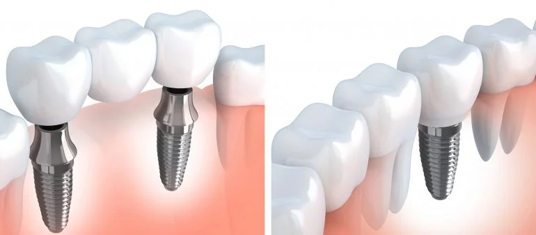 Dental Implants In Islamabad Pakistan