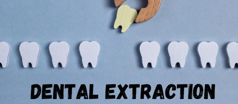 Expert Tooth Extraction Services in Islamabad at Kensington Dental