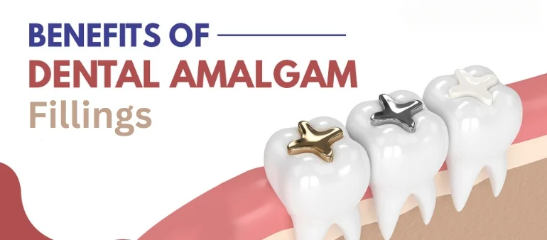 How Amalgam Fillings Provide Long-Lasting Dental Solutions