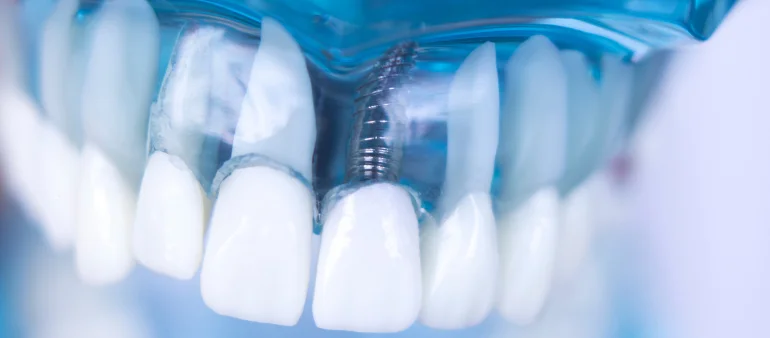 How Hyflex EDM Technology Ensures Superior Outcomes in Dental Implants