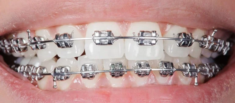 Metal Brackets: A Reliable Solution for Straightening Teeth