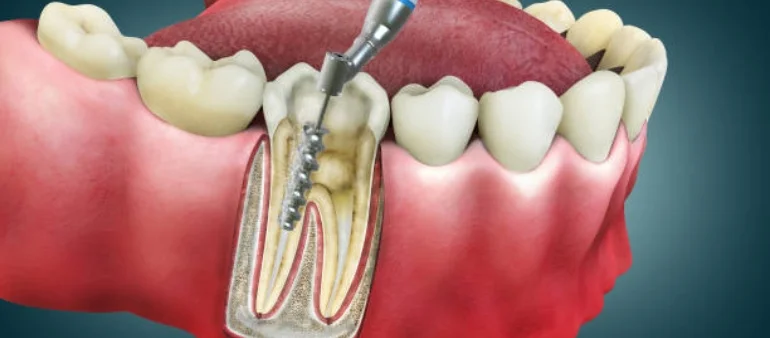 Root Canal Treatment In Islamabad