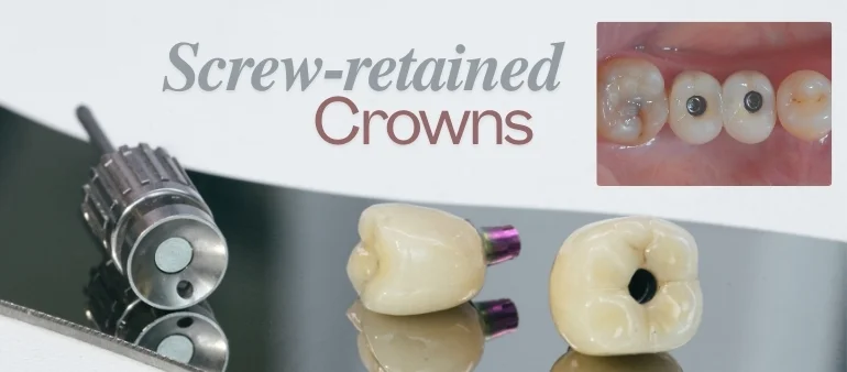 Screw retained crowns at KDiC Islamabad