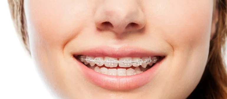 The Benefits of Ceramic Braces for a Discreet Smile