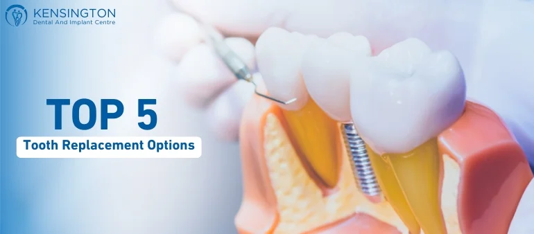 Top 5 Affordable Tooth Replacement Options 