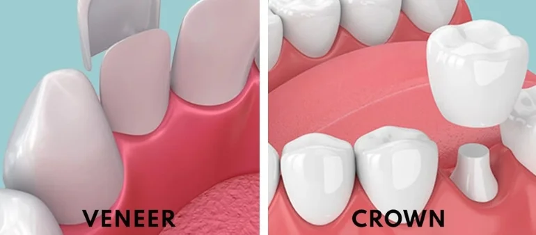 Veneers vs Crowns: Which Is Right for You?