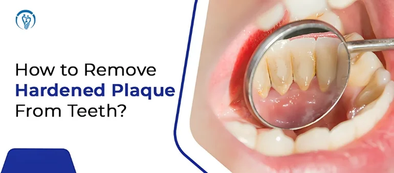 What Is Dental Plaque? Easy Tips to Eliminate It