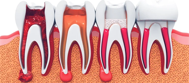 What to Expect During Endodontic Root Canal Therapy